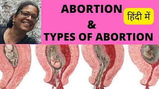 AbortionTypes of abortion in obstetricsTypes of abortion and managementAbortion types hindi [upl. by Elexa976]