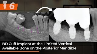 BD Cuff implant at the limited vertical available bone on the posterior Mandible [upl. by Refotsirc]