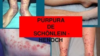 Purpura de Henoch schonlein  conferencia pediatria [upl. by Icrad]