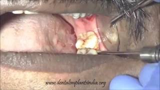 Second Third mandibular molar extraction by cowhorn forceps [upl. by Ammeg956]