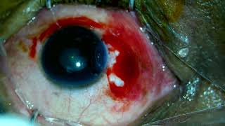 Pterygium Excision Autograft Cautery [upl. by Leirad984]