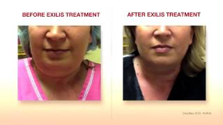 Exilis Elite Face Treatment Amara Clinic [upl. by Kcirevam777]