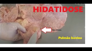 Hidatidose  Cisto Hidático viavel [upl. by Elak132]