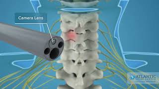 What is Endoscopic Posterior Cervical Discectomy and Foraminotomy AtlanticSpineCenter [upl. by Betsey]