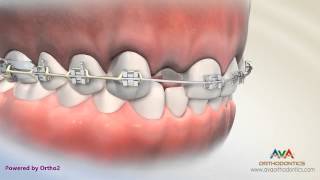 Orthodontic amp Restorative Treatment for Missing Lateral Incisor  Different Options [upl. by Azirb]