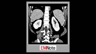 Portal Vein Thrombosis doctor medical [upl. by Rosecan]