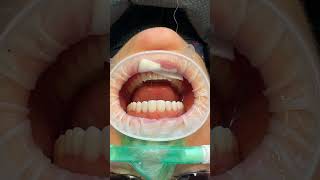 Flossing dentist veneers [upl. by Man]