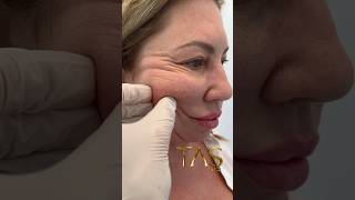 20 Years Back with Scarless Facelift by ProfDrSuleyman Tas facelift drsuleymantas [upl. by Eldrid790]