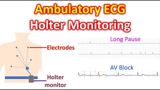 Ambulatory ECG Holter Monitoring [upl. by Stillas]