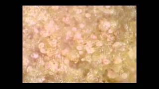 Scabies mites on skin crust [upl. by Collins]