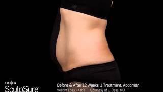 SculpSure Body Contouring  Before amp After Images [upl. by Faletti]