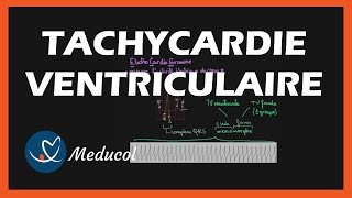 Tachycardie Ventriculaire ECG symptômes et traitement [upl. by Yerxa418]