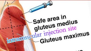 How to give an intramuscular injection in the buttocks [upl. by Connel]