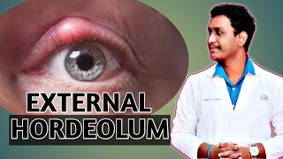 external hordeolum eyelid diseases external hordeolum case presentation 2021 [upl. by Rivy]