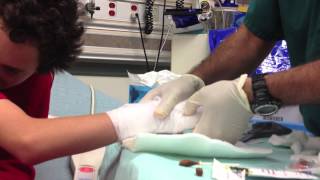 Boxers Fracture  reduction  and splinting [upl. by Ymmas257]