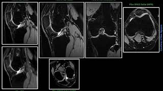 MR MSK Imaging – PDw SPACE FatSat  Prisma 3T [upl. by Mae]