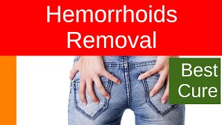 Hemorrhoids Removal [upl. by Tema204]