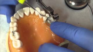 Class II Amalgam Restoration Instructions by Dr Ywom [upl. by Lhadnek]