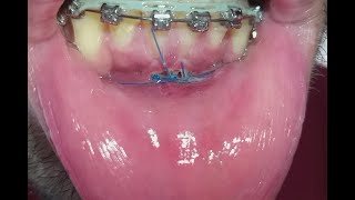 Frenectomy and Wisdom Tooth Extraction Recession gum [upl. by Theodoric]