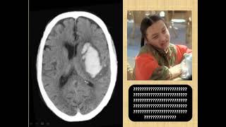 INTRACRANIAL HEMORRHAGE MANAGEMENT PART 3B [upl. by Sauer]