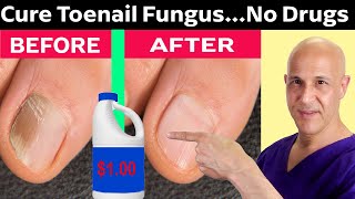 How to Cure Toenail Fungus for Pennies a Day Dr Mandell [upl. by Traci54]