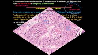 113P How to tell a benign and malignant tumor apart Differentiation and Anaplasia [upl. by Voorhis]