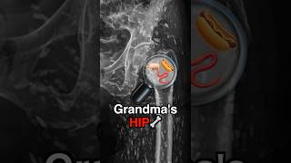 Undercooked Pork Led to Grandmas Seizure amp Broken Hip [upl. by Ahel]