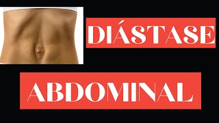 Exercícios para a diástase abdominal [upl. by Jacinda616]