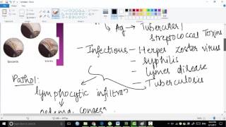 episcleritis  ophthalmology [upl. by Barbra]