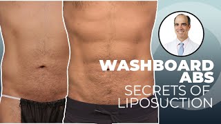 Liposuction for Guys How to get rid of love handles and get a sixpack [upl. by Chrisy]