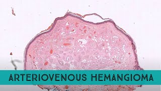 quotArteriovenousquot Hemangioma pathology dermpath dermatology dermatopathology [upl. by Washko]