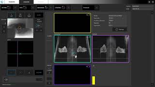 Anterior segment OCT 2 angles Part 23 [upl. by Yanehc324]