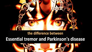 The difference between essential tremor and Parkinsons disease [upl. by Krisha773]