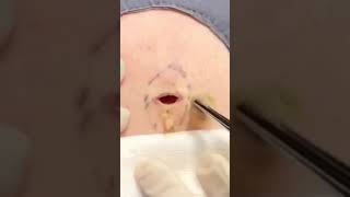 Dr Pimple Popper vs A Surprise Opening shorts [upl. by Budge]