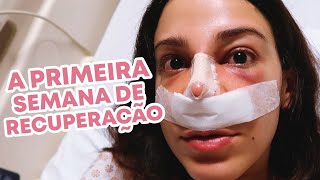 RECUPERAÇÃO DA RINOPLASTIA Primeira Semana Pós Cirúrgica [upl. by Elaynad]