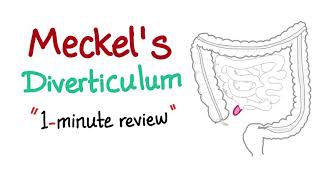 Meckels Diverticulum 1minute review [upl. by Cavill]