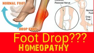 Foot Drop  Peroneal Nerve Injury  Foot Drop Homeopathic Treatment by samridhi sharma [upl. by Serene561]