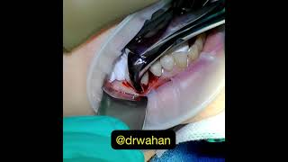 Cowhorn Dental Extraction Video [upl. by Koeninger524]