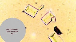 Triple Phosphate Crystals under microscope at 40X [upl. by Hort]