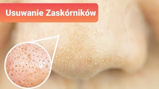 5 naturalnych sposobów na usunięcie zaskórników [upl. by Enelrak]