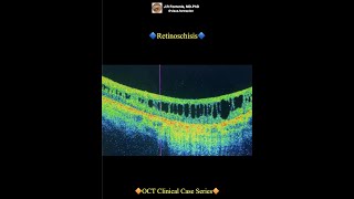 Retinoschisis [upl. by Smailliw309]