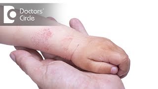 How to manage Atopic Dermatitis in children  Dr Divya Sharma [upl. by Arihk362]