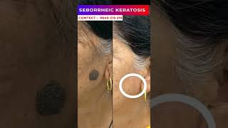 Seborrheic Keratosis treatment at Skinaa clinic viralshorts serborrheickeratosis skinaaclinic [upl. by Geraint]