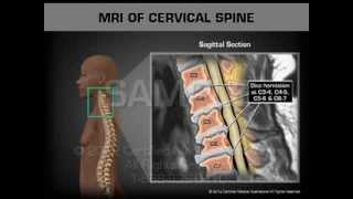 MRI of Cervical Spine [upl. by Okeim]