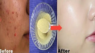 Corn flour acne pimple face maskpack Diy 🌽🌽🌽 [upl. by Mcdermott]