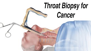 How a Throat Biopsy is Performed to Check for Throat Cancer [upl. by Ynohtnaluap]