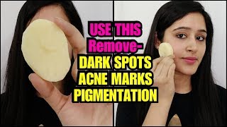 APPLY THIS ON YOUR FACE to Remove DARK SPOTS PIMPLE MARKS amp PIGMENTATION [upl. by Ahsinahs]