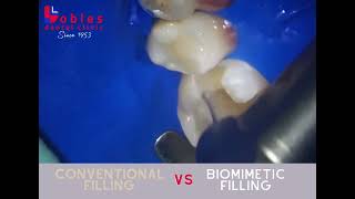 Old Style filling VS Biomimetic filling [upl. by Chute]