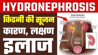 Hydronephrosis हाइड्रोनफ्रोसिस या क‍िडनी में सूजन के कारण लक्षण और इलाज  hydronephrosis treatment [upl. by Jopa]