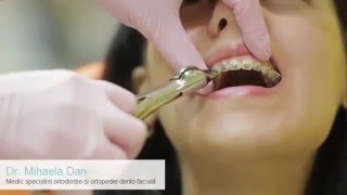 Cum se scoate un aparat dentar fix  ORTO IMPLANT EXPERT [upl. by Nehgaem]